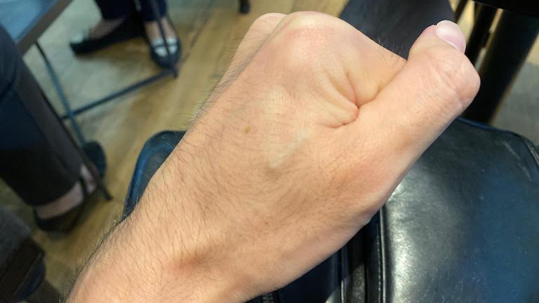 マイクロチップ埋め込み1年半後