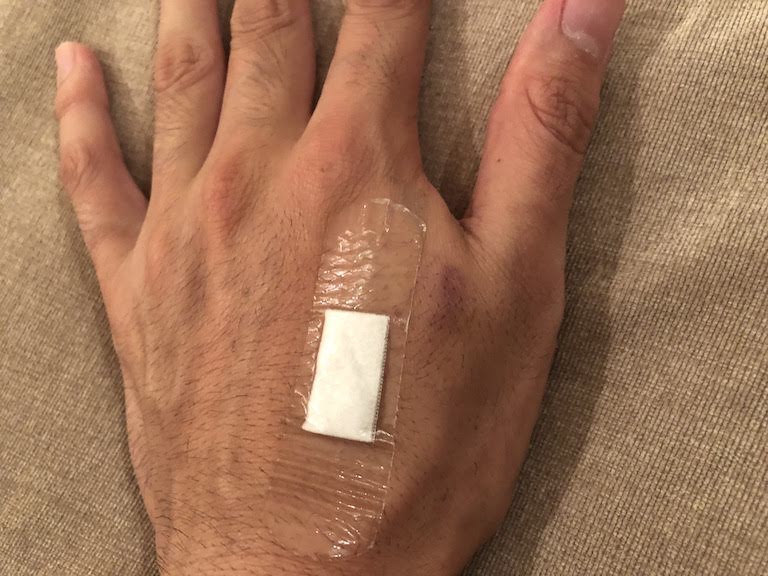 マイクロチップ埋め込み3日後